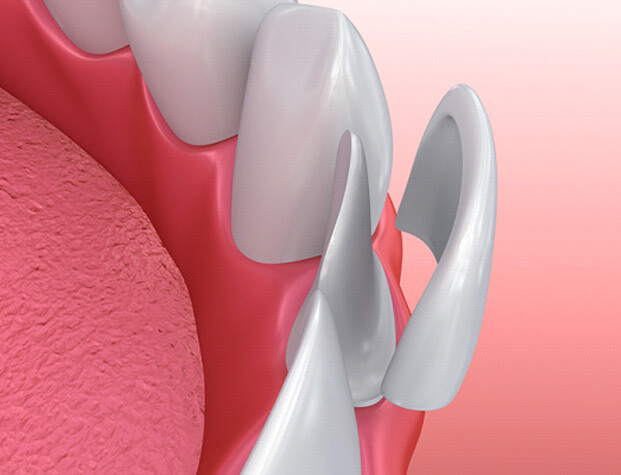 model of veneer for lower tooth