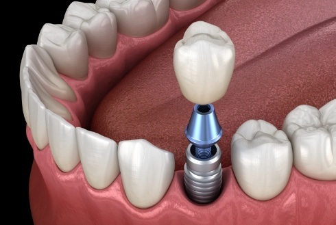 Dental crown being placed onto dental implant