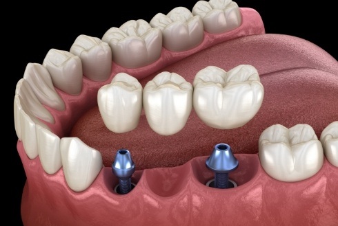 Dental bridge being placed onto two dental implants