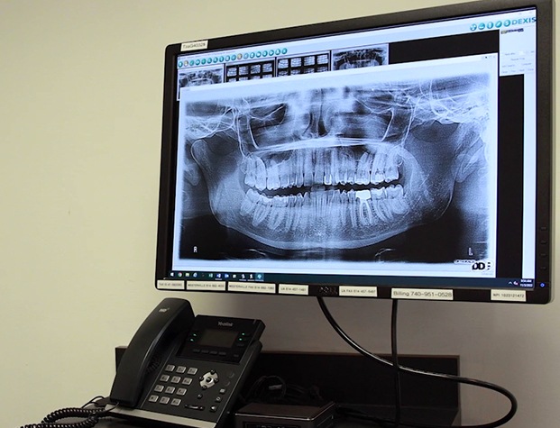 Digital x ray of teeth on computer screen
