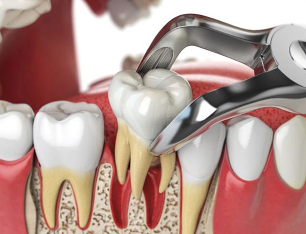 Illustration of forceps performing a tooth extraction