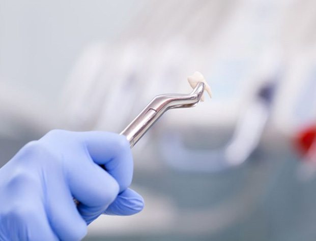 Gloved hand holding dental forceps and extracted tooth