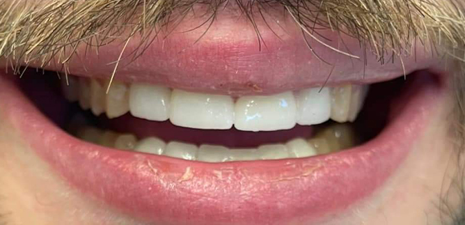 Close up of man smiling with flawless teeth thanks to Upper Arlington dentists