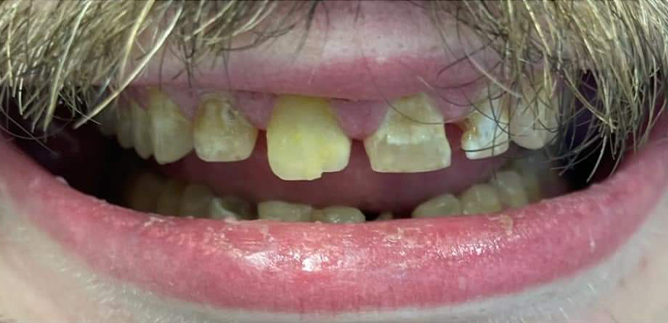 Close up of man smiling with damaged teeth