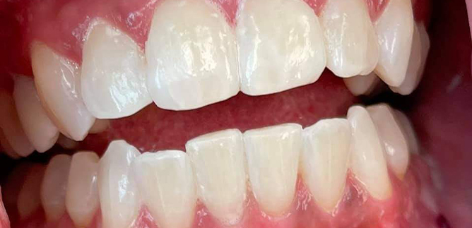 Close up of bright white front teeth