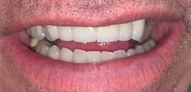 Close up of aligned teeth