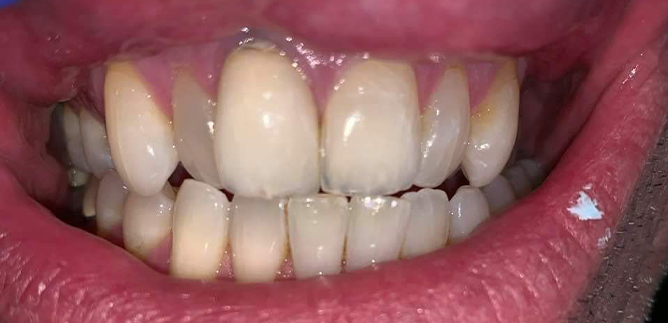 Close up of uneven teeth