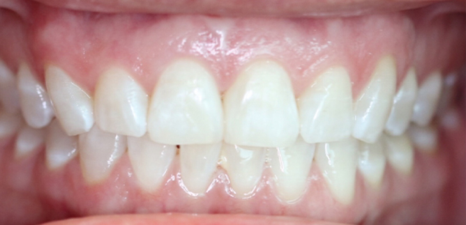 Row of whiter teeth