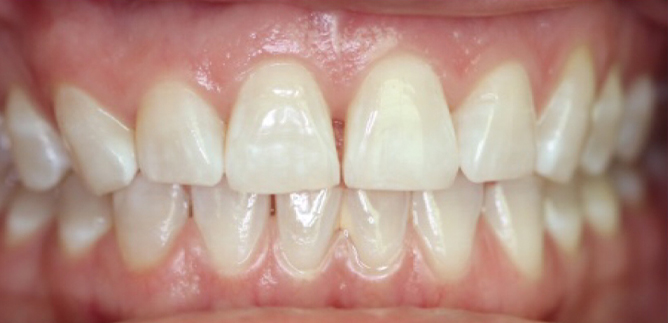 Row of slightly yellowed teeth