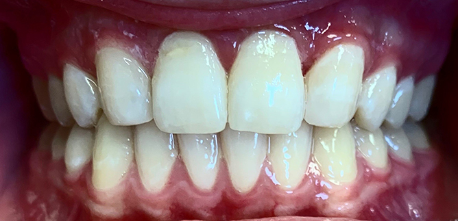 Mouth after fixing chipped teeth