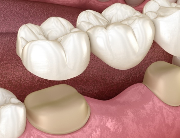 Illustrated dental bridge replacing a missing tooth