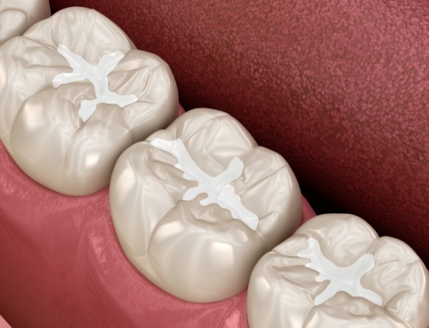 Illustrated row of teeth with barely noticeable tooth colored fillings