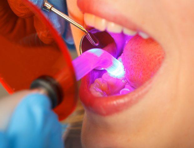Close up of dental patient receiving direct bonding on their tooth