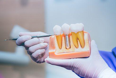 Dentist pointing to a dental implant model