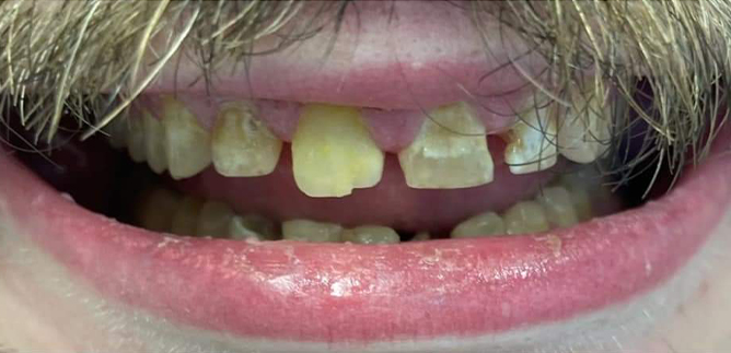 Smile Transformation Before 1