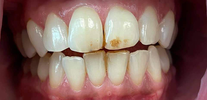 Smile Transformation 