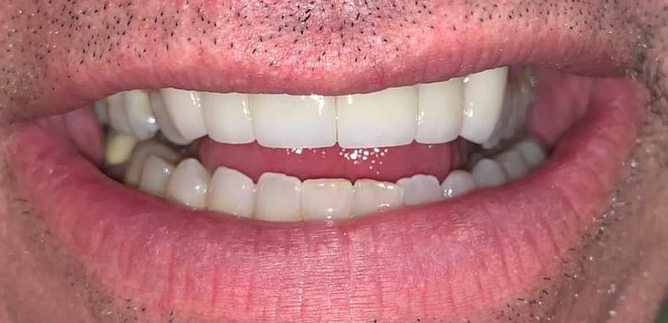 Smile Transformation 