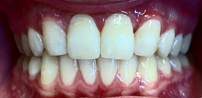 Smile Transformation 