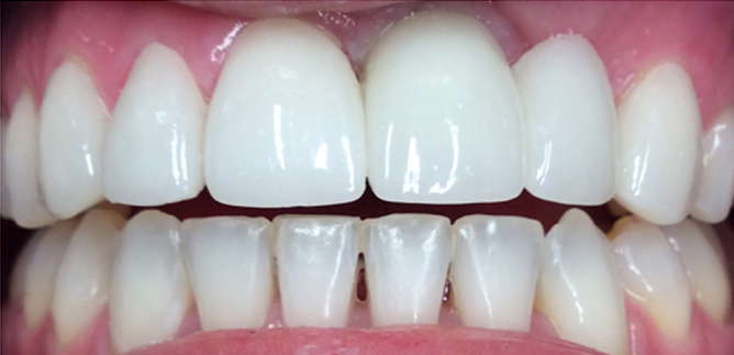 Smile Transformation 
